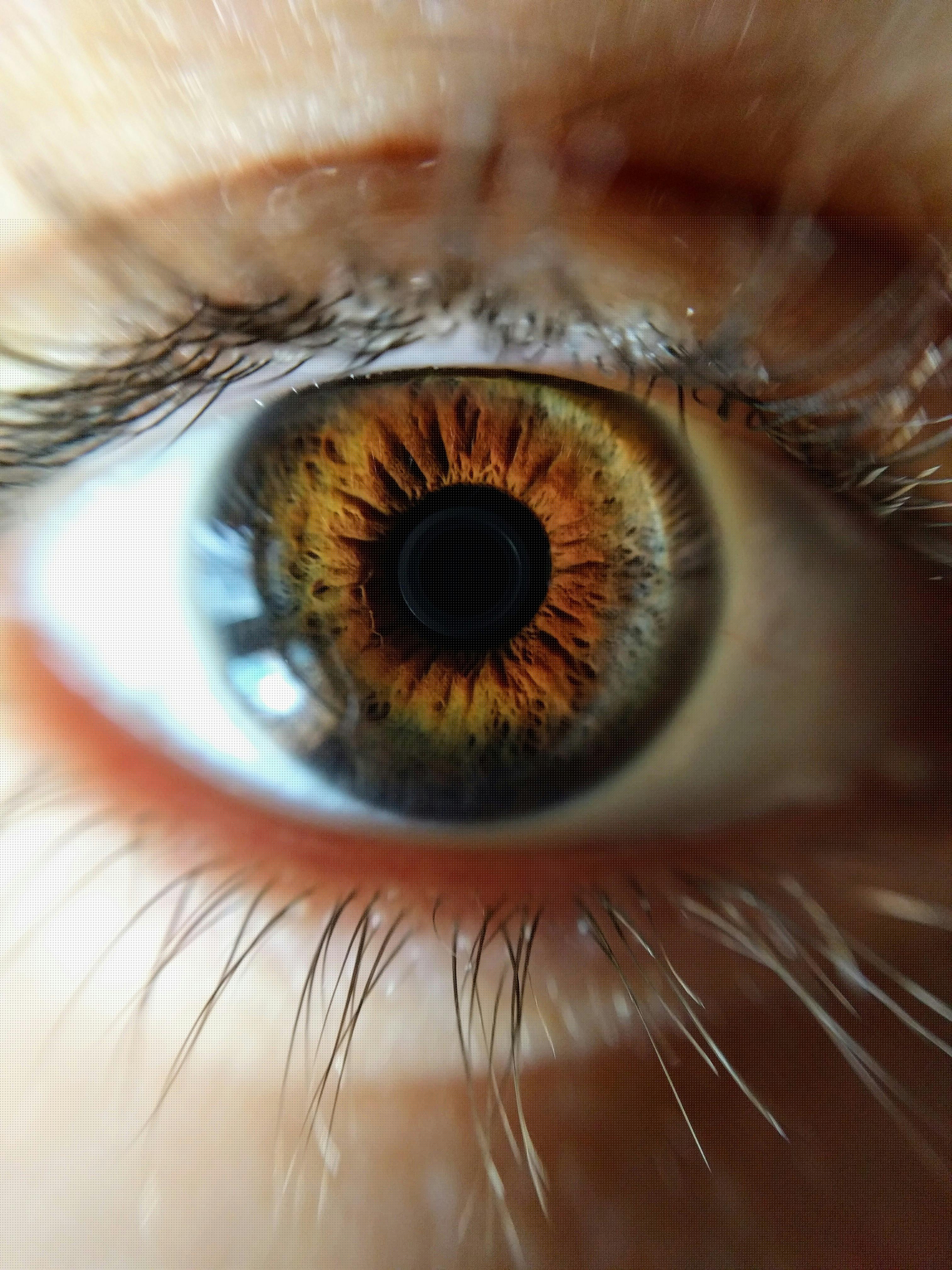 Cornea Conditions